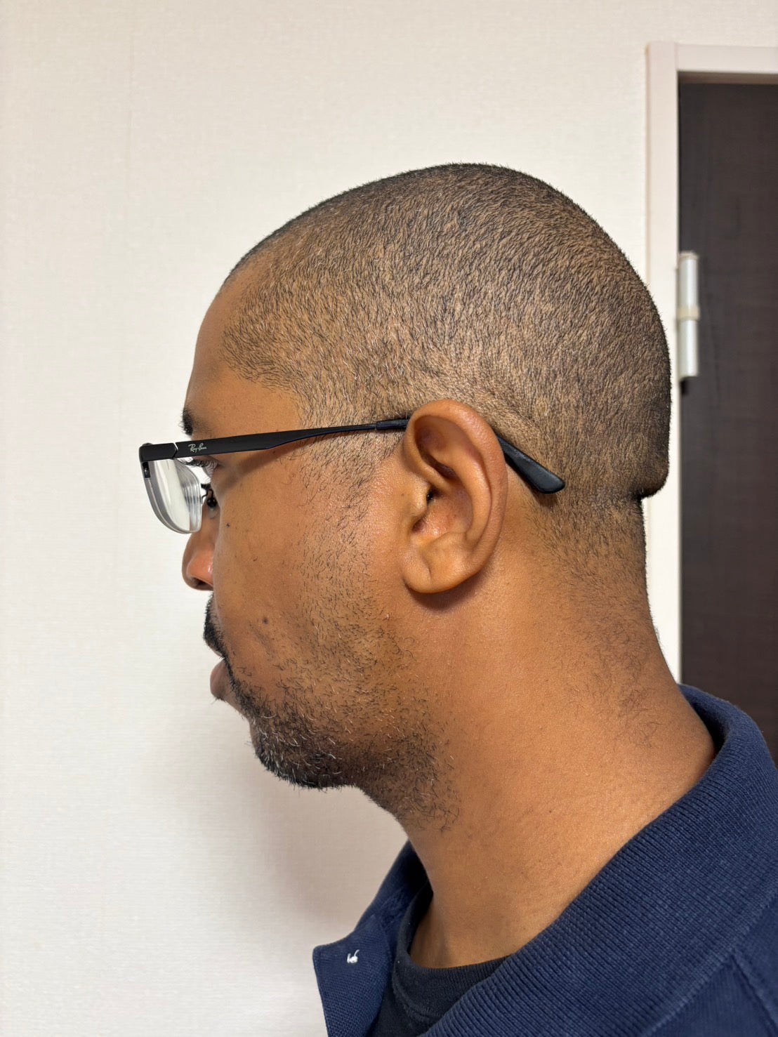 How effective did the gel cream prevent post-shave irritation and hair bumps?